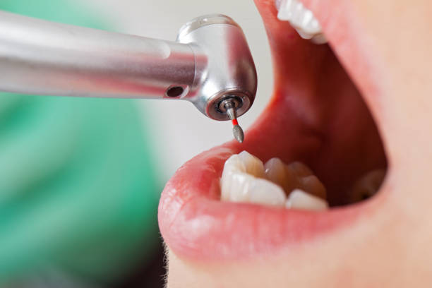 Best Broken or Cracked Tooth Emergency Dentist in Jonesboro, IN